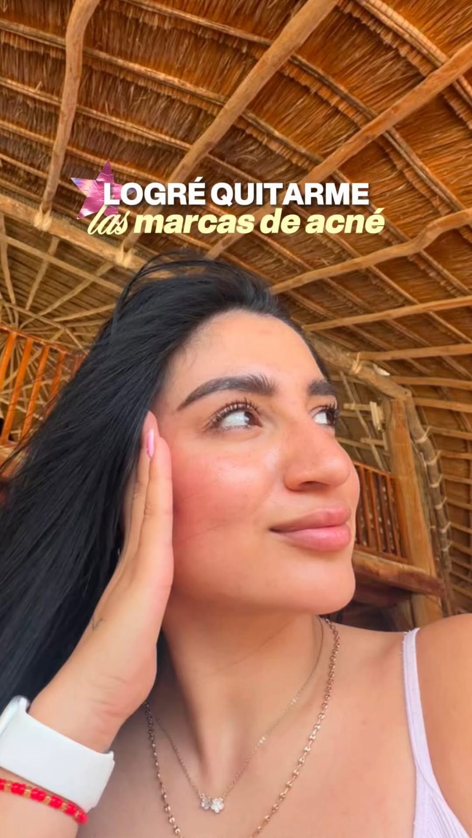 Camila Quiroga en primer plano en contenido de Radiant Skin sobre marcas de acné